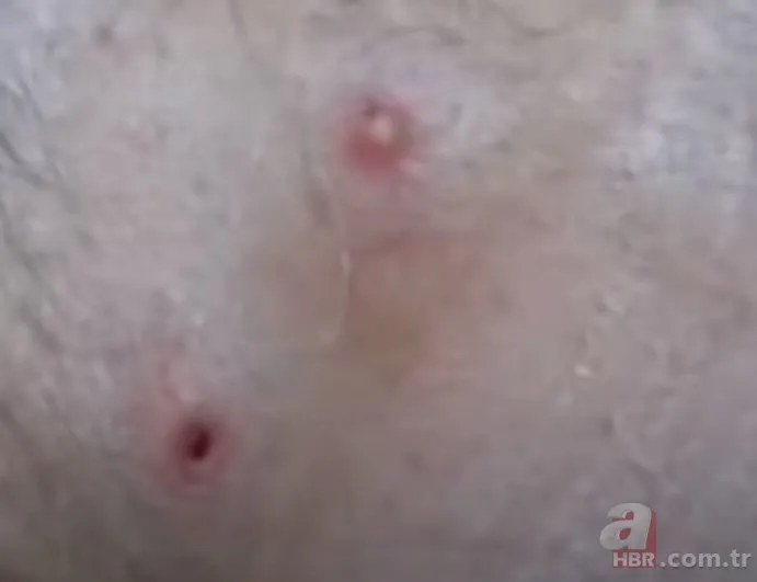 Sırtındaki yarayı sivilce zannetti ama gerçek dehşete düşürdü! Bakın içinden ne çıktı 18