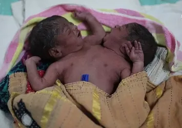 Bangladeş'te yapışık ikizler dünyaya geldi