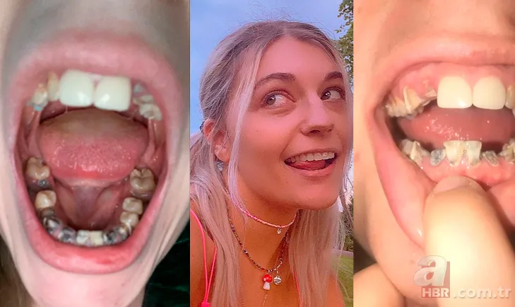 Herkes aynı hatayı yapıyor! 23 yaşında bütün dişleri döküldü 1