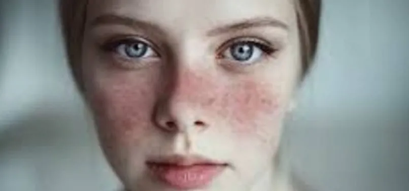 lupus sle hastaligi nedir lupus