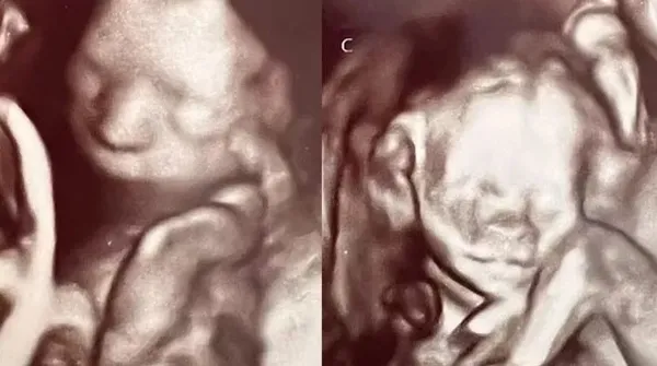ABD’de şoke eden olay! Ultrasonda ortaya çıktı 70 milyonda bir görülüyor
