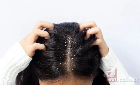 1 damlası bile yetiyor! Şampuanın içine bunu ekleyin! Saç derinizi tertemiz yapacak! Egzama, kaşıntı, kepek... 9