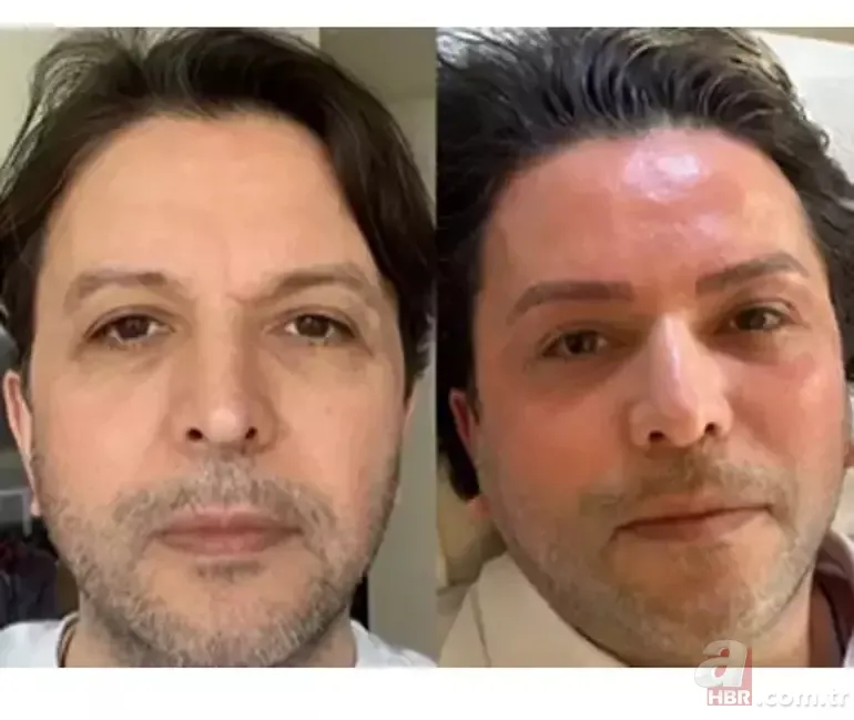 Estetik yaptıran Nihat Doğan'ı görenler şoke oldu! Son hali dillere düştü 6