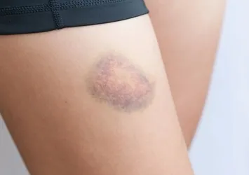 Kolay morarma hemofili habercisi olabilir