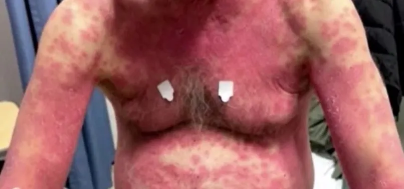 ABD’de koronavirüse karşı yapılan Johnson and Johnson aşısı bu hale getirdi