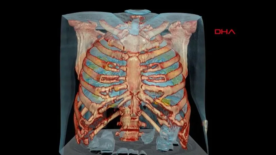 Corona virüs Covid-19 akciğerleri bu hale getiriyor! İşte koronavirüslü akciğerin 3D görüntüsü | Video