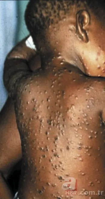 Maymun çiçek virüsü yeni salgına davetiye çıkardı! Avrupa’da vaka sayısı artışta, tedavisi yok 7