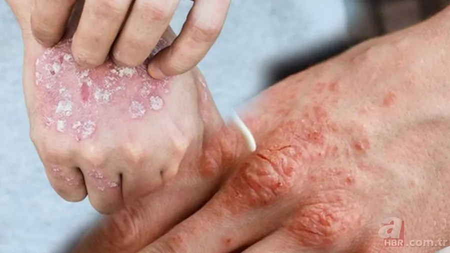 Kuruluğa, kızarıklığa ve acıya son! Eldeki kaşıntı ve egzamayı rahatlatacak yöntem! Tek damlasını sürünce... 1