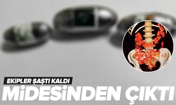 Midesinden 774 parça kapsül çıkarıldı! Ekipler şaştı kaldı