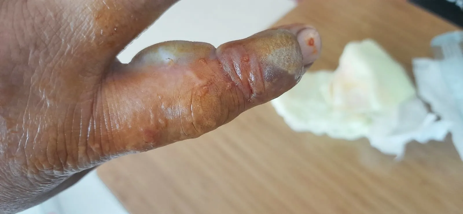 Bursa'da kendisini ısıran yılanla birlikte hastaneye koştu🐍 Ölümle yaşam arasında mücadele