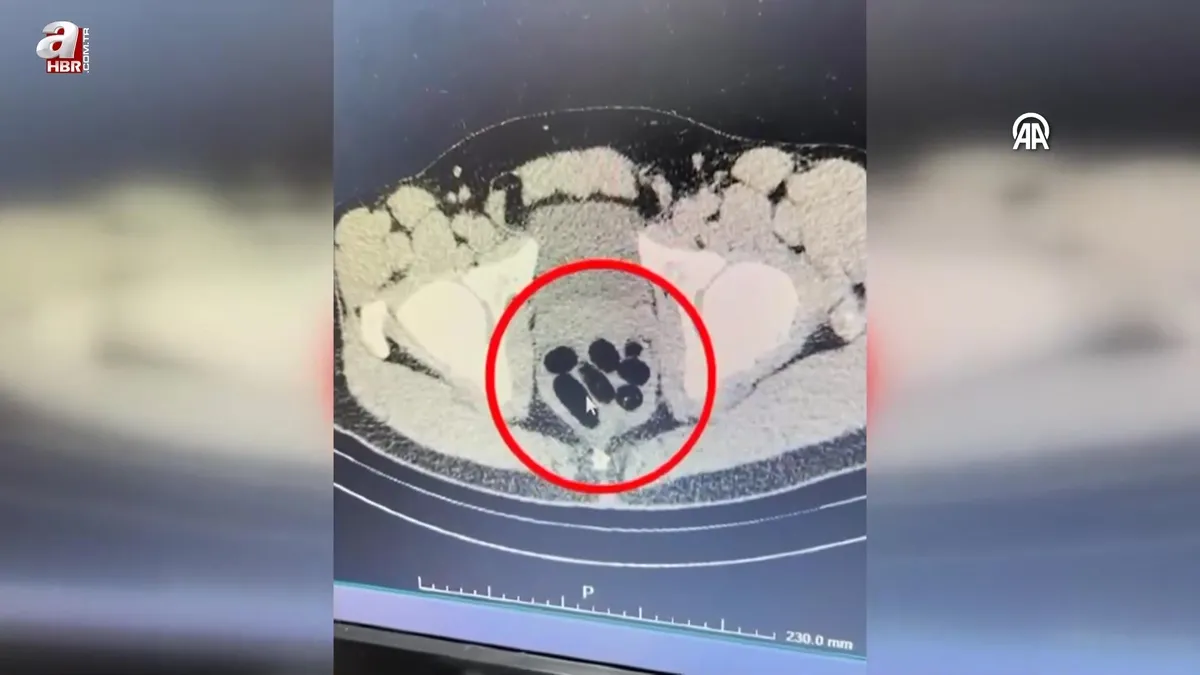 Kadının midesinden çıktı! Gözaltına alındı