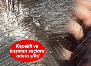 Kaşınan ve kepeklenen saçınız varsa dikkat! Bu yöntemle hem rahatlayacak hem de saçınızı uzatacaksınız