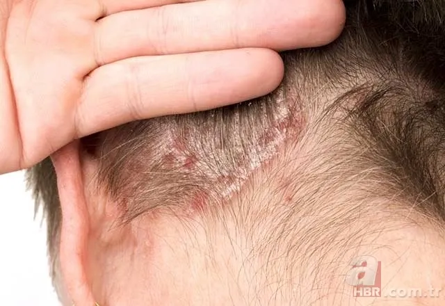 Egzamanızı tek 1 damlasıyla tarihe gömüyor! Saç kökünde kaşıntı, kepek, ağrı şikayetiniz varsa... 9