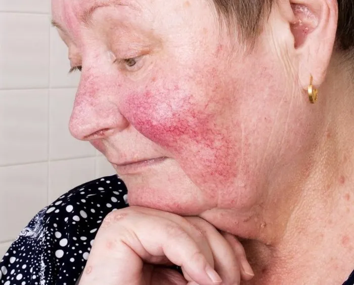 Gül hastalığı nedir? Gül hastalığı belirtileri ve nedenleri...