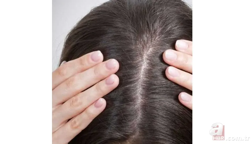 Kaşınan ve kepeklenen saçınız varsa dikkat! Bu yöntemle hem rahatlayacak hem de saçınızı uzatacaksınız 8