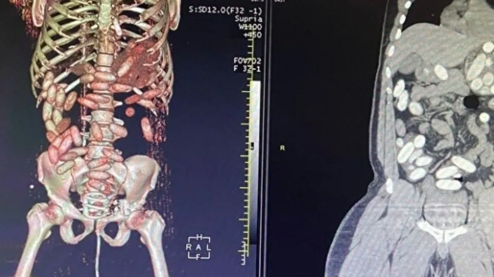 İstanbul Havalimanı’nda uyuşturucu operasyonu! 7 yolcunun midesinden 11 kilo eroin çıktı