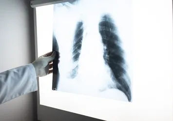 Akciğer kanserinde erken teşhis hayat kurtarıyor