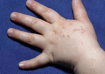 Uzmanı uyardı: El ve ayak hastalığı havuz suyundan bulaşabilir!