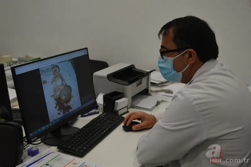 40 binde bir görülüyor! Kilosu kadar tümörle dünyaya geldi | Dünyanın en ilginç hastalıkları 3