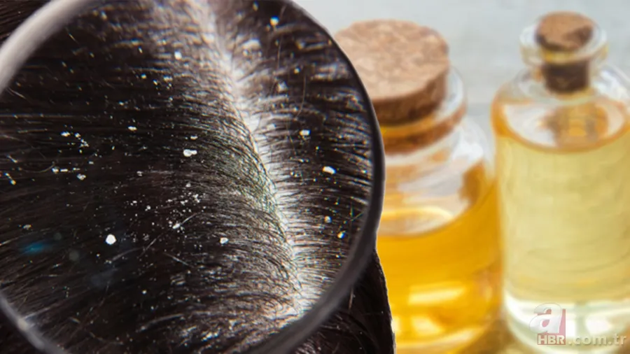 1 damlası bile yetiyor! Şampuanın içine bunu ekleyin! Saç derinizi tertemiz yapacak! Egzama, kaşıntı, kepek... 1