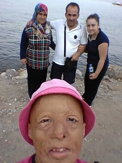 balikesirde-2-yasindan-beri-47-kez-ameliyat-oldu-yeni-yuzune-kavustu-allah-devletimizden-razi-olsun-1673957323310.jpg