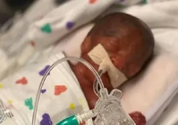 ABD'li doktorların 'doğmaları mucize' dediği ikizler