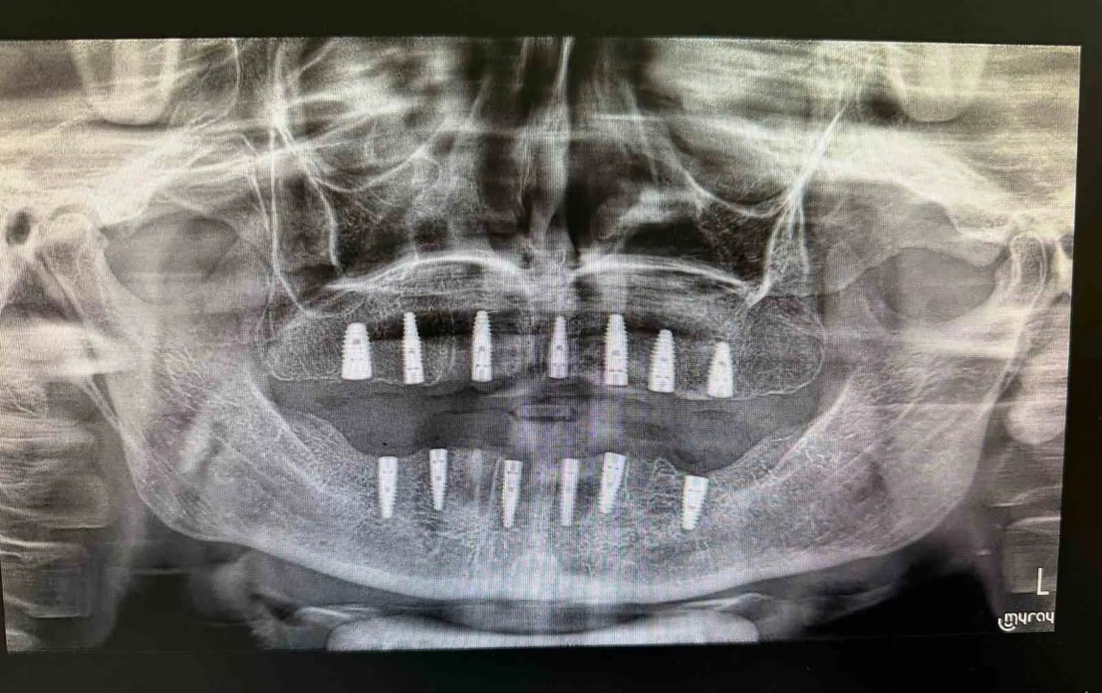 Tamamen dişsiz hastanın implantla hayatı değişti