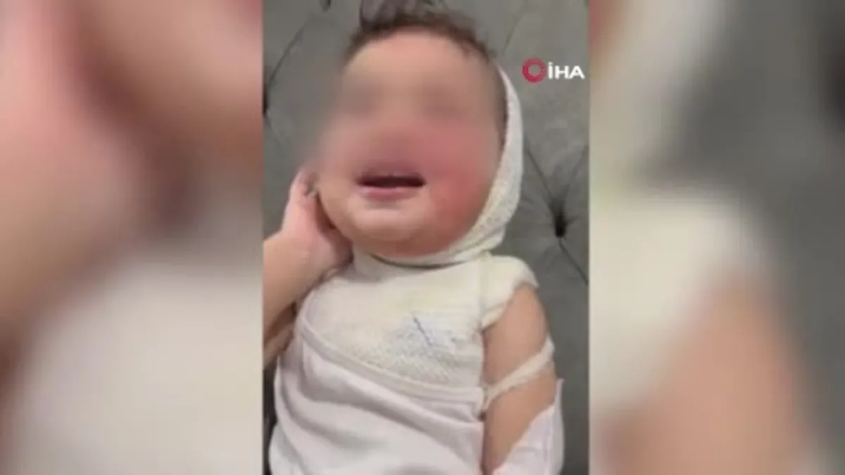 Adana'da Kreşte çocuğun üzerine kahve döküldü