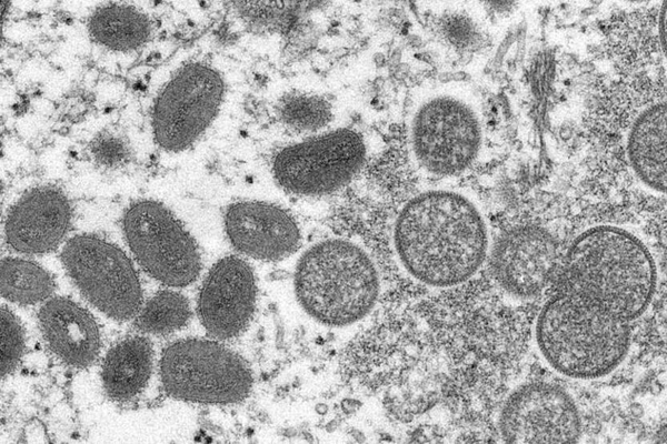 Maymun Çiçeği hastalığında flaş ihmal! Avrupa'daki doktorlar hatalı mı? - 6