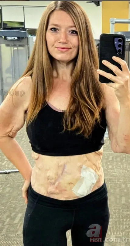 2 yılda 140 kilo veren kadının ilham veren hikayesi! O hastalığa rağmen... 9