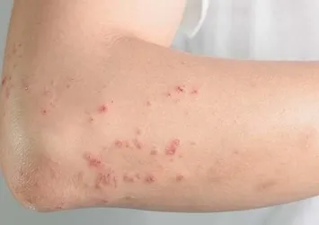Zona hastalığı nedir belirtileri nelerdir?