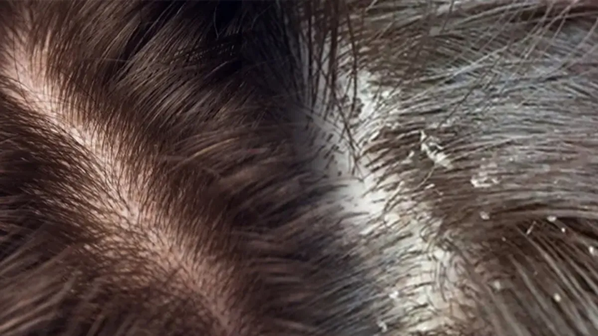 Kepek ve egzamayı geçiren yöntem! Saç dipleriniz tertemiz olacak!