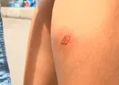 Avcılarda sivrisinek kabusu!