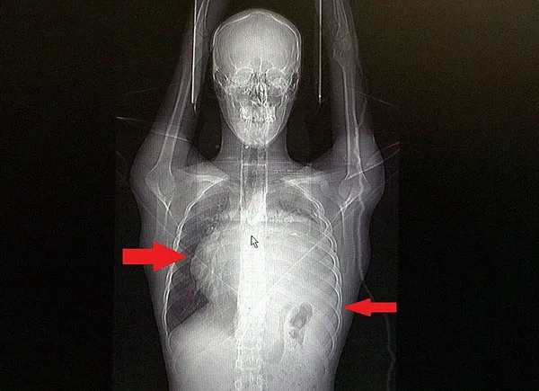 1699190528936.jpeg Röntgeni görünce doktorlar bile şaşkına döndü! Kalbi 12 santim kaydı, içinden kilolarca... - 1