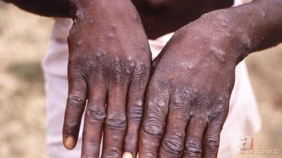 Maymun Çiçeği virüsü nedir, öldürür mü? Maymun Çiçeği hastalığının belirtileri neler, tedavisi var mı? Türkiye'de görüldü mü? 1