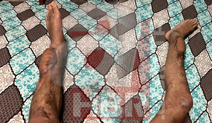 chp-ilce-baskaninin-carparak-sakat-biraktigi-genc-olayinin-perde-arkasi-o-genc-sadece-a-habere-anlatti-1767114783198.jpg Berk Tütüncü’nün çarpmasının ardından olay yerinde bırakılan Hacı Resul Düzgün’ün ayağının son hali (AHABER.COM.TR)