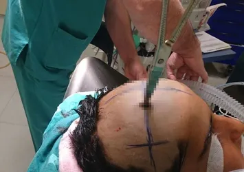 Abisinin attığı makas başına saplandı