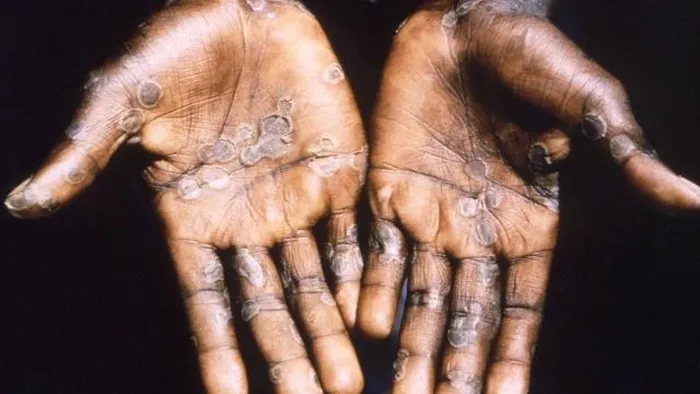 Güney Afrika’dan Maymun Çiçeği virüsü açıklaması: Kontrol altında