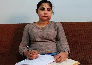 Türkiye'de yüz nakli olan ilk kadın öldü