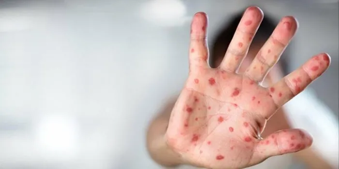 Maymun çiçeği virüsü Avrupa'ya sıçradı! Çok daha bulaşıcı bir varyant DSÖ: Maymun çiçeği uluslararası önem arz eden bir halk sağlığı acil durumu  oluşturuyor