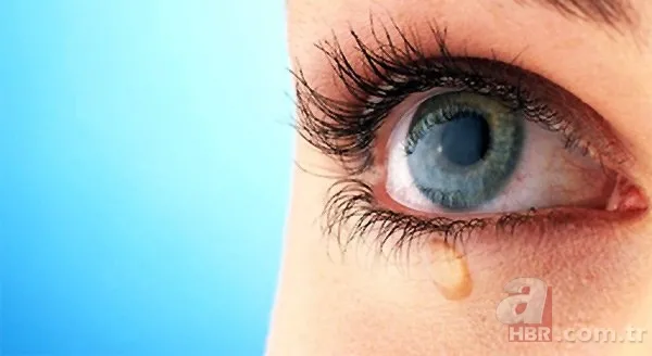 Gözde arpacık neden çıkar, nasıl geçer? 20
