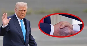 Trump’ın elindeki morlukların nedeni belli oldu