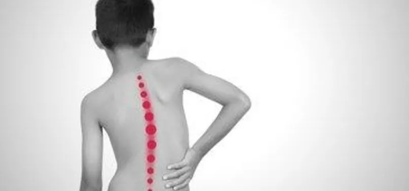 Skolyozun Sakasi Yok Skolyoz Nedir Ve Nasil Olusur