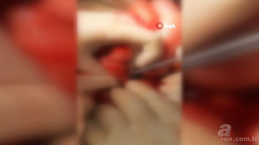 Amasya’da 22 yaşındaki genç kız karın ağrısı şikayetiyle hastaneye gitti! Gerçek şoke etti: Tam 5 kilo 17