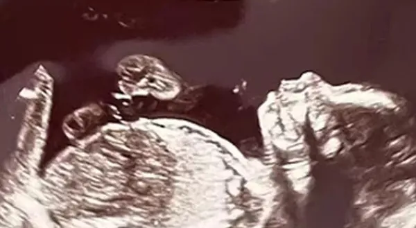 ABD’de şoke eden olay! Ultrasonda ortaya çıktı 70 milyonda bir görülüyor