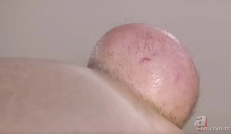 Sokağa şapka ile çıkıyordu! Başındaki şişlikten bakın ne çıktı 👩⚕️ Görenleri şaşkına çeviren olay 8