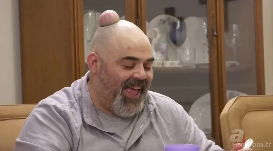 Sokağa şapka ile çıkıyordu! Başındaki şişlikten bakın ne çıktı 👩⚕️ Görenleri şaşkına çeviren olay 24