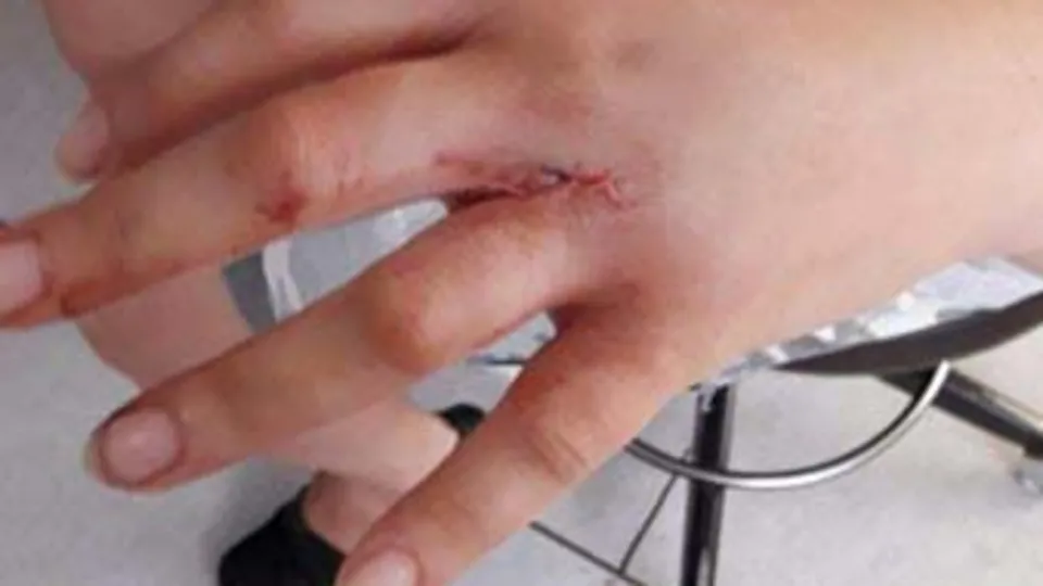 İğneli vatoz sokunca bakın ne hale geldi