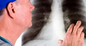 Akciğer kanseri belirtileri nelerdir?