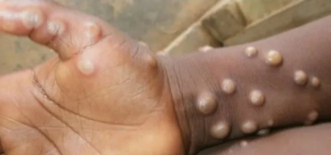 Maymun çiçeği vakaları yayılıyor! Vaka sayısı 6 binin üzerine çıktı! Vakaların yüzde 80’i Avrupa’da...